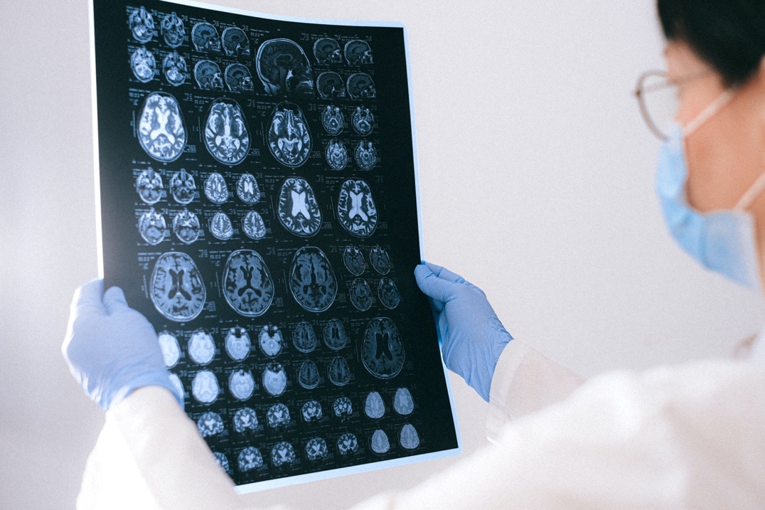 Estos son los tipos comunes de lesiones cerebrales causadas por negligencia médica