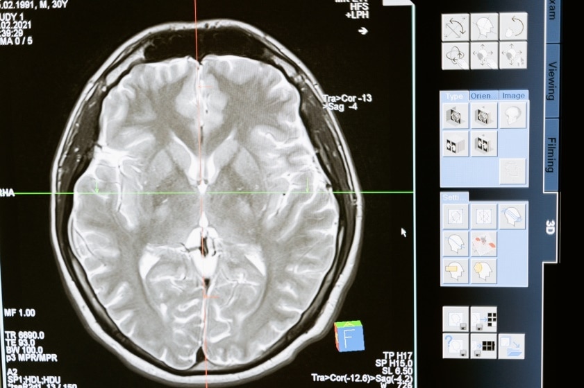 Can Slip and Fall Accidents Cause Serious Brain Injuries?