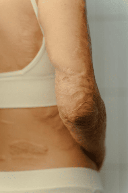 Why Burn Injury Victims Sue and What Makes a Strong Case