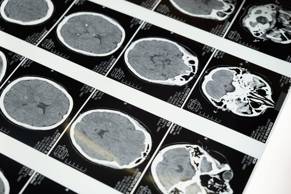 Traumatic brain injury