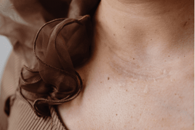 The Psychological Impact of Burn Injuries and How to Cope With It
