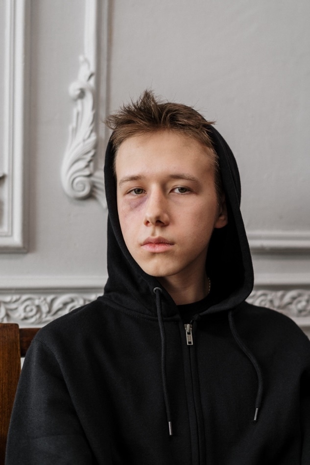 A boy with bruised eyes.