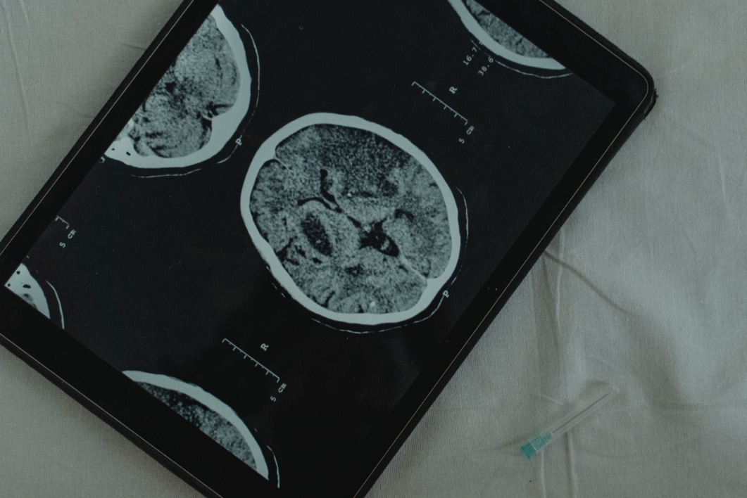 Isolated vs. Non-Isolated Traumatic Brain Injuries