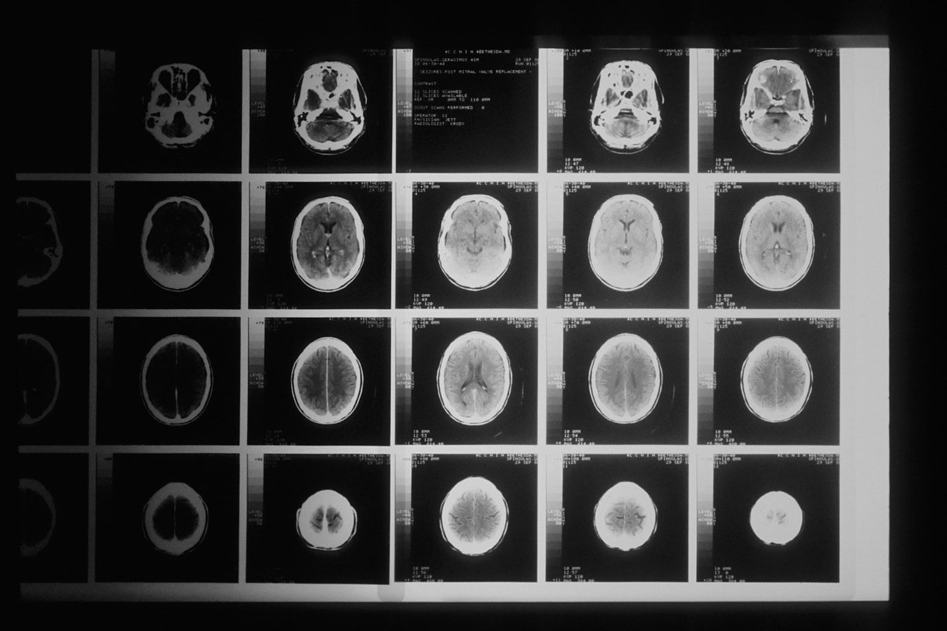 How to Choose a Brain Injury Lawyer in Nevada