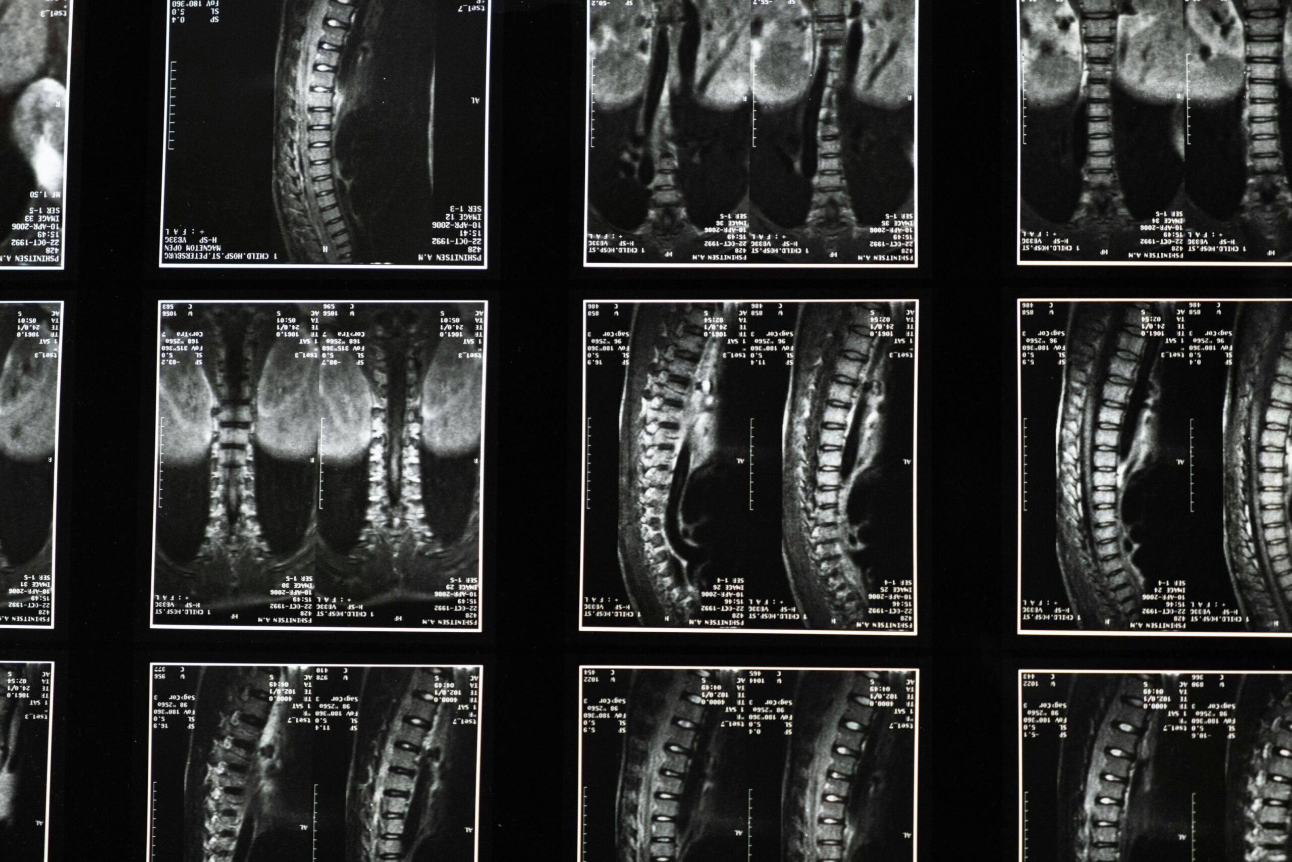 Medical images of a backbone relevant to a spinal injury lawsuit.